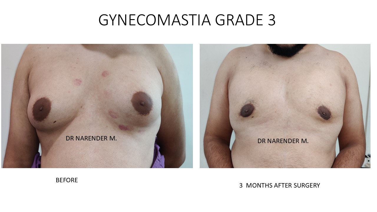 Gynecomastia Photo 5